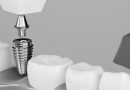 ACTILINK: An Advanced Device to Improve Dental Implant Treatment Success Rates